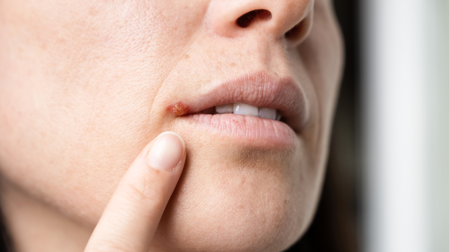 Demystifying Herpes Sores: Appearance, Stages, and What to Know ...